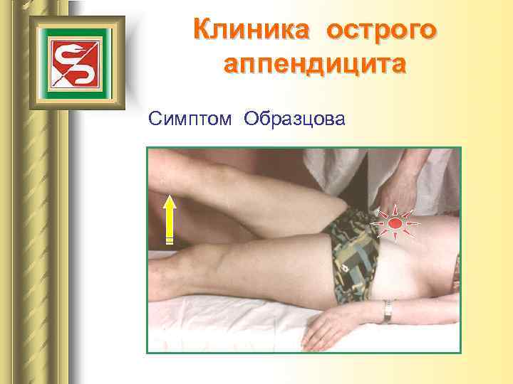 Клиника острого аппендицита Симптом Образцова 