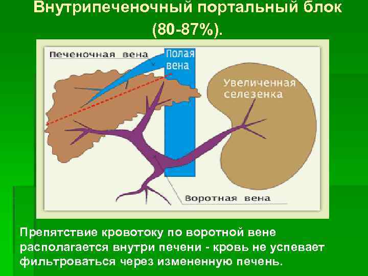 Внутрипеченочный портальный блок (80 -87%). Препятствие кровотоку по воротной вене располагается внутри печени -