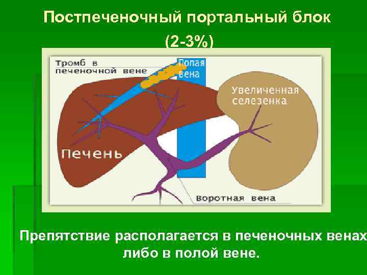 Постпеченочный портальный блок (2 -3%) Препятствие располагается в печеночных венах либо в полой вене.