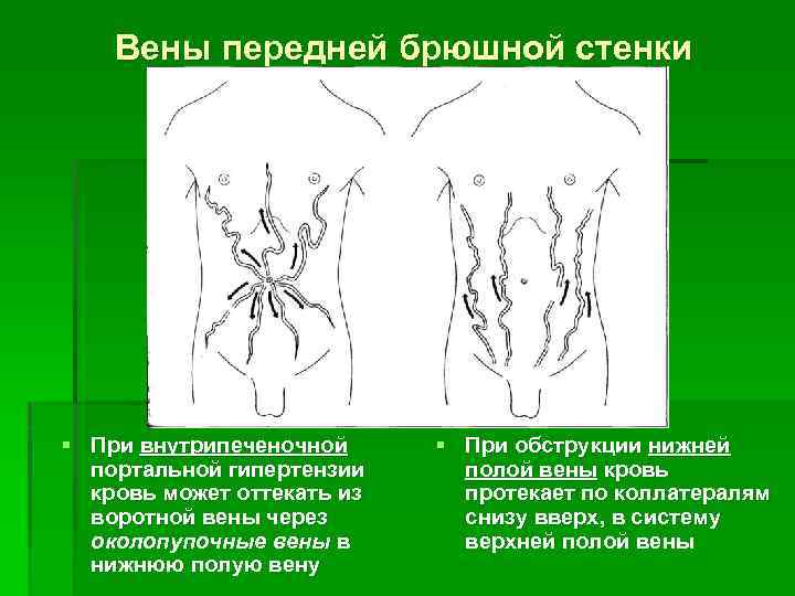 Вены передней брюшной стенки § При внутрипеченочной портальной гипертензии кровь может оттекать из воротной