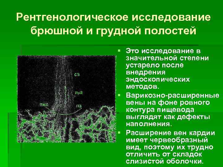 Рентгенологическое исследование брюшной и грудной полостей § Это исследование в значительной степени устарело после