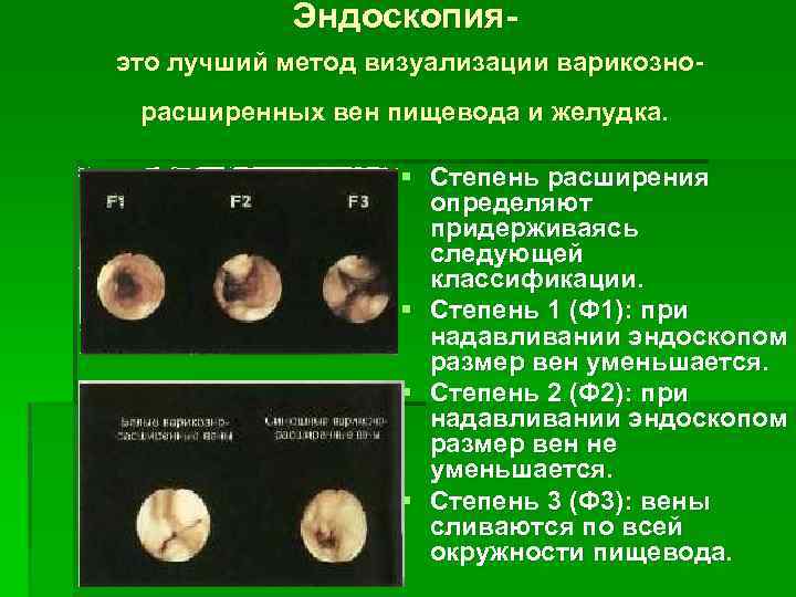 Эндоскопия это лучший метод визуализации варикознорасширенных вен пищевода и желудка. § Степень расширения определяют