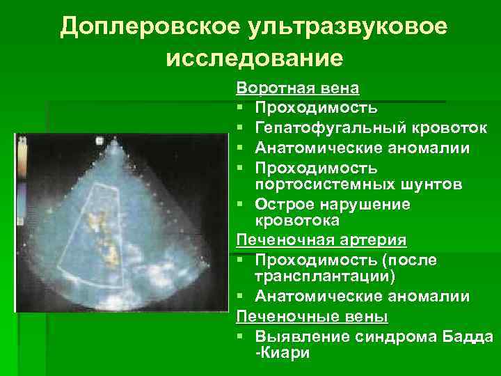 Доплеровское ультразвуковое исследование Воротная вена § Проходимость § Гепатофугальный кровоток § Анатомические аномалии §