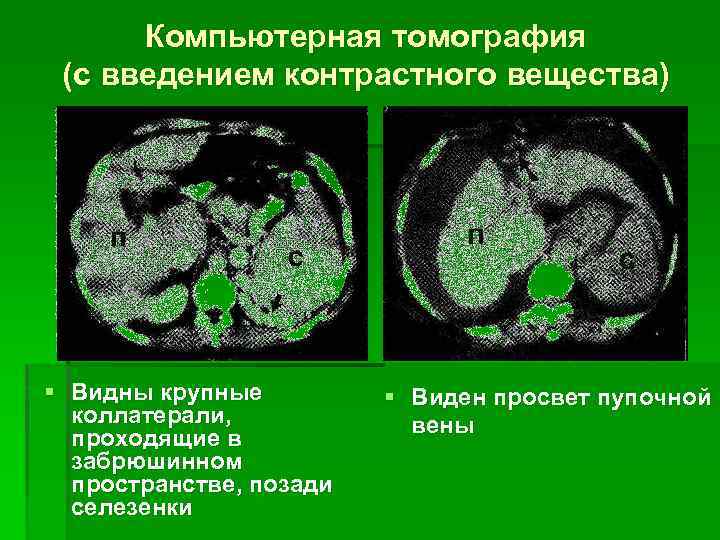 Компьютерная томография (с введением контрастного вещества) § Видны крупные коллатерали, проходящие в забрюшинном пространстве,