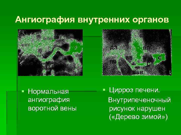 Ангиография внутренних органов § Нормальная ангиография воротной вены § Цирроз печени. Внутрипеченочный рисунок нарушен