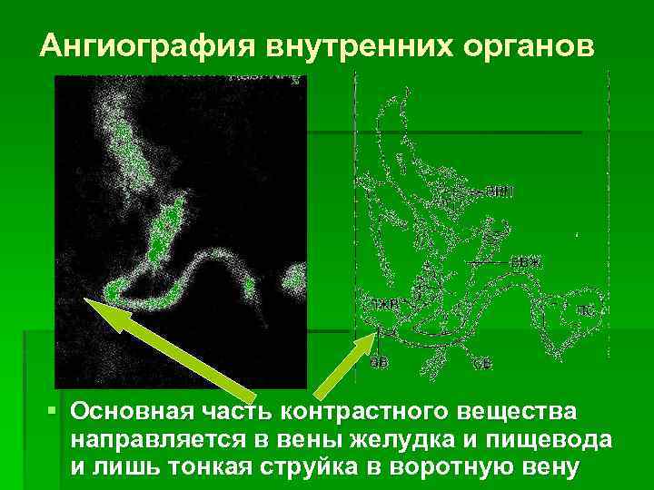 Ангиография внутренних органов § Основная часть контрастного вещества направляется в вены желудка и пищевода