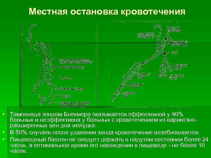 Местная остановка кровотечения § Тампонада зондом Блекмора оказывается эффективной у 90% больных и неэффективна