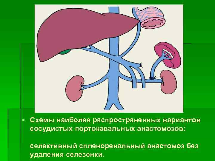 § Схемы наиболее распространенных вариантов сосудистых портокавальных анастомозов: селективный спленоренальный анастомоз без удаления селезенки.