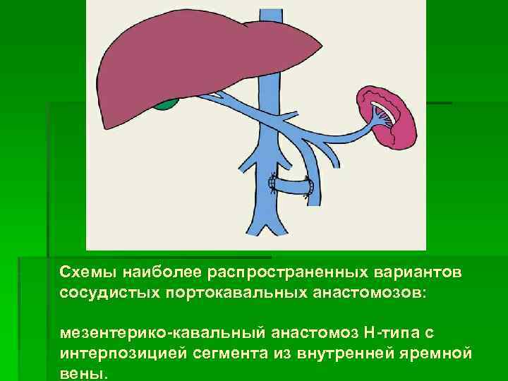 Схемы наиболее распространенных вариантов сосудистых портокавальных анастомозов: мезентерико-кавальный анастомоз Н-типа с интерпозицией сегмента из