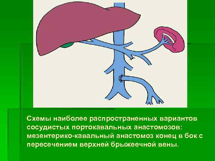 Схемы наиболее распространенных вариантов сосудистых портокавальных анастомозов: мезентерико-кавальный анастомоз конец в бок с пересечением