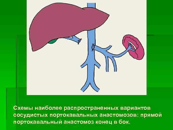 Схемы наиболее распространенных вариантов сосудистых портокавальных анастомозов: прямой портокавальный анастомоз конец в бок. 