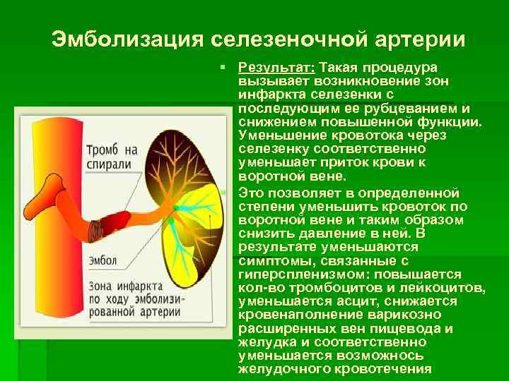 Эмболизация селезеночной артерии § Результат: Такая процедура вызывает возникновение зон инфаркта селезенки с последующим