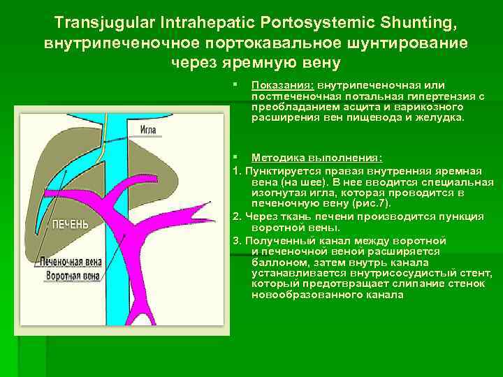 Transjugular Intrahepatic Portosystemic Shunting, внутрипеченочное портокавальное шунтирование через яремную вену § Показания: внутрипеченочная или