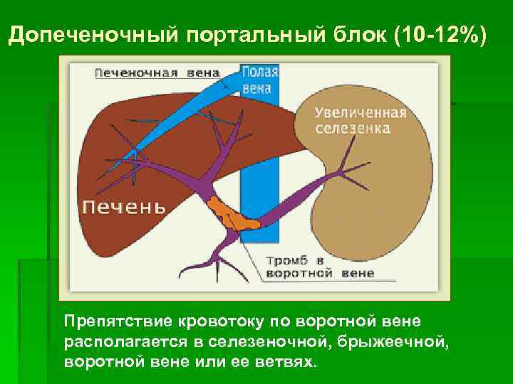 Допеченочный портальный блок (10 -12%) Препятствие кровотоку по воротной вене располагается в селезеночной, брыжеечной,