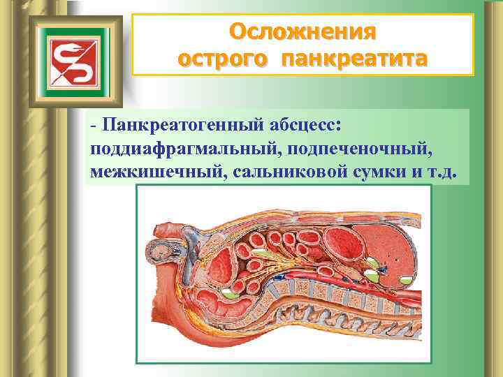 Осложнения острого панкреатита - Панкреатогенный абсцесс: поддиафрагмальный, подпеченочный, межкишечный, сальниковой сумки и т. д.