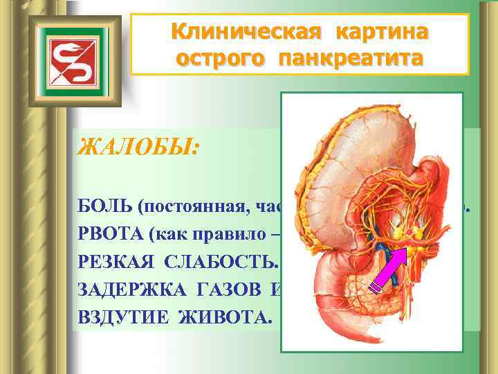 Клиническая картина острого панкреатита ЖАЛОБЫ: БОЛЬ (постоянная, часто – опоясывающая). РВОТА (как правило –