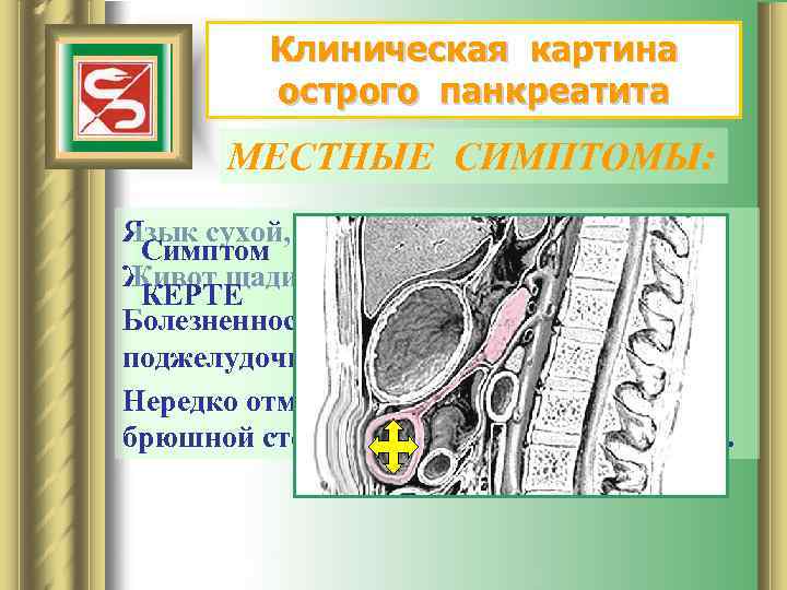 Клиническая картина острого панкреатита МЕСТНЫЕ СИМПТОМЫ: Язык сухой, обложен налетом. Симптом Живот щадится при