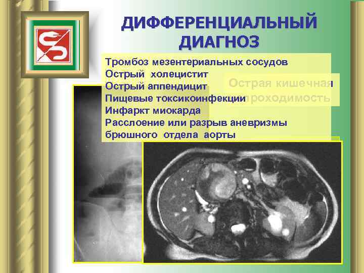 ДИФФЕРЕНЦИАЛЬНЫЙ ДИАГНОЗ Тромбоз мезентериальных сосудов Острый холецистит Острая кишечная Острый аппендицит Пищевые токсикоинфекции непроходимость