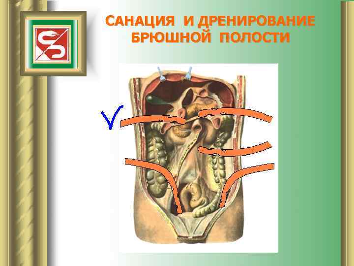 САНАЦИЯ И ДРЕНИРОВАНИЕ БРЮШНОЙ ПОЛОСТИ 