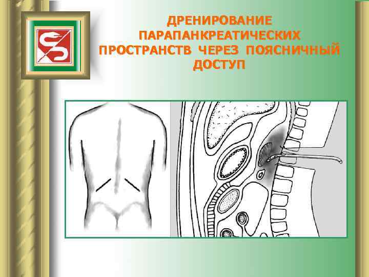 ДРЕНИРОВАНИЕ ПАРАПАНКРЕАТИЧЕСКИХ ПРОСТРАНСТВ ЧЕРЕЗ ПОЯСНИЧНЫЙ ДОСТУП 