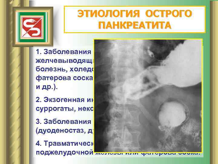 ЭТИОЛОГИЯ ОСТРОГО ПАНКРЕАТИТА 1. Заболевания внепеченочных желчевыводящих путей (желчно-каменная болезнь, холедохолитиаз, спазм или стеноз