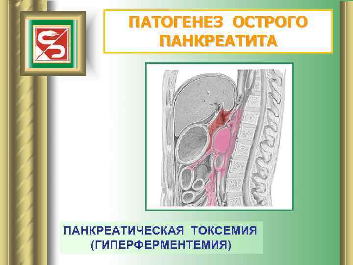 ПАТОГЕНЕЗ ОСТРОГО ПАНКРЕАТИТА ПАНКРЕАТИЧЕСКАЯ ТОКСЕМИЯ (ГИПЕРФЕРМЕНТЕМИЯ) 