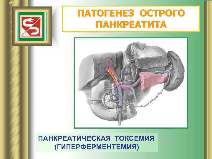 ПАТОГЕНЕЗ ОСТРОГО ПАНКРЕАТИТА ПАНКРЕАТИЧЕСКАЯ ТОКСЕМИЯ (ГИПЕРФЕРМЕНТЕМИЯ) 