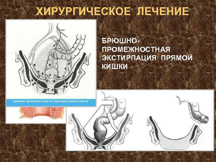 ХИРУРГИЧЕСКОЕ ЛЕЧЕНИЕ БРЮШНОПРОМЕЖНОСТНАЯ ЭКСТИРПАЦИЯ ПРЯМОЙ КИШКИ 