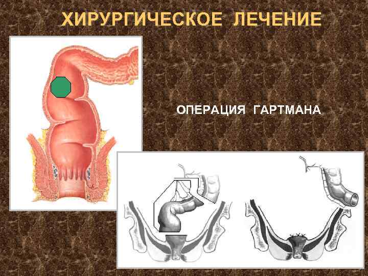 ХИРУРГИЧЕСКОЕ ЛЕЧЕНИЕ ОПЕРАЦИЯ ГАРТМАНА 