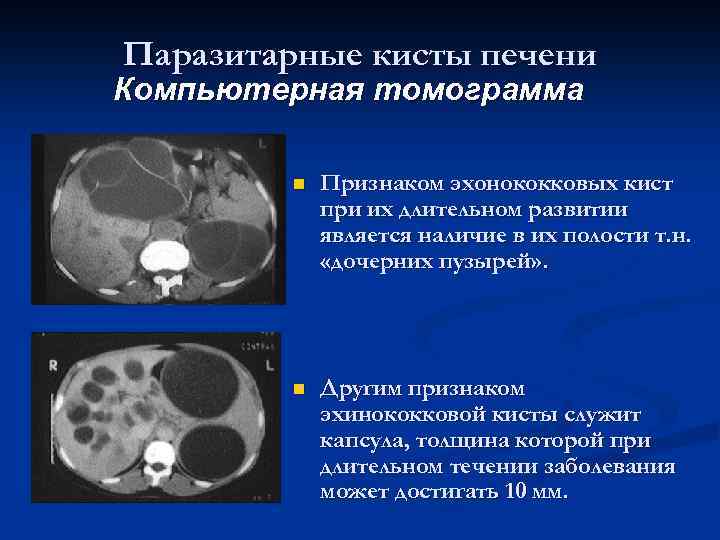 Паразитарные кисты печени Компьютерная томограмма n Признаком эхонококковых кист при их длительном развитии является