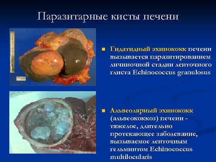 Паразитарные кисты печени n Гидатидный эхинококк печени вызывается паразитированием личиночной стадии ленточного глиста Echinococcus