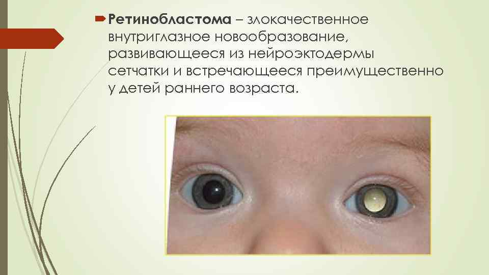  Ретинобластома – злокачественное внутриглазное новообразование, развивающееся из нейроэктодермы сетчатки и встречающееся преимущественно у