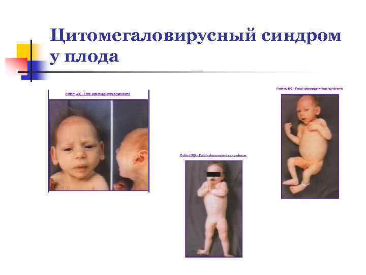 Цитомегаловирусный синдром у плода 