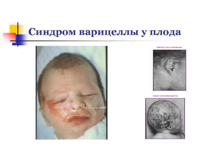 Синдром варицеллы у плода 