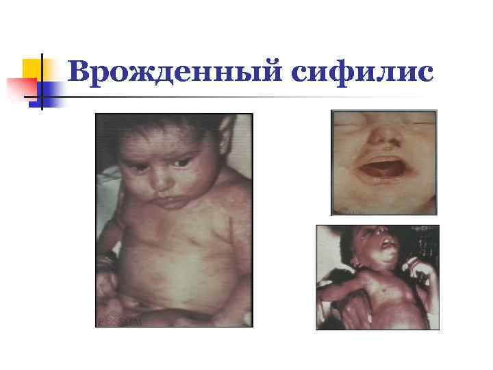 Врожденный сифилис 