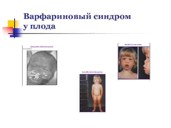 Варфариновый синдром у плода 