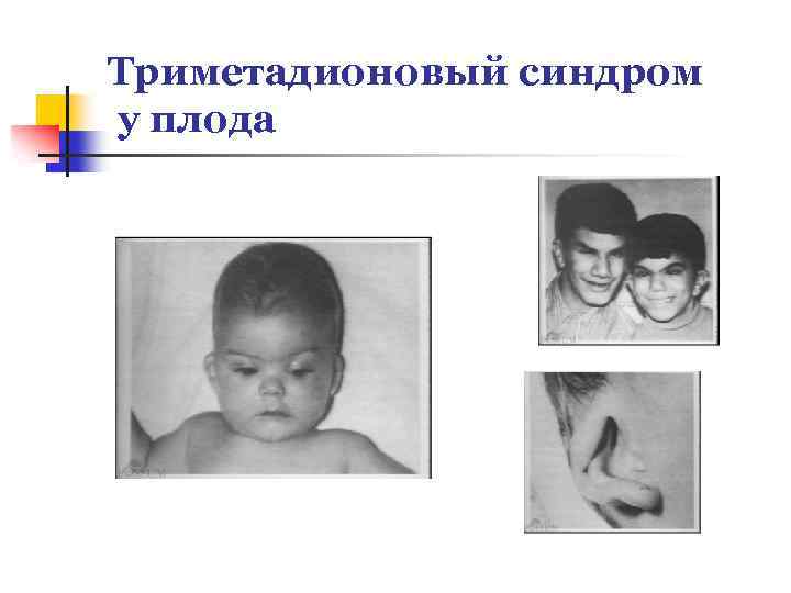 Триметадионовый синдром у плода 