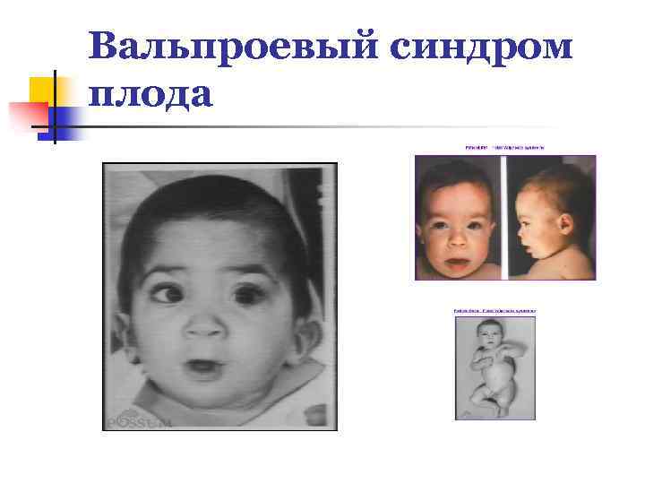 Вальпроевый синдром плода 