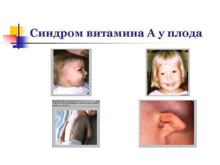Синдром витамина А у плода 