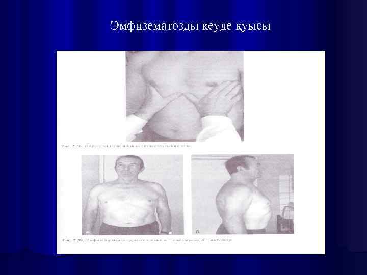 Эмфизематозды кеуде қуысы 