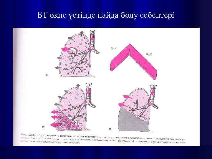 БТ өкпе үстінде пайда болу себептері 