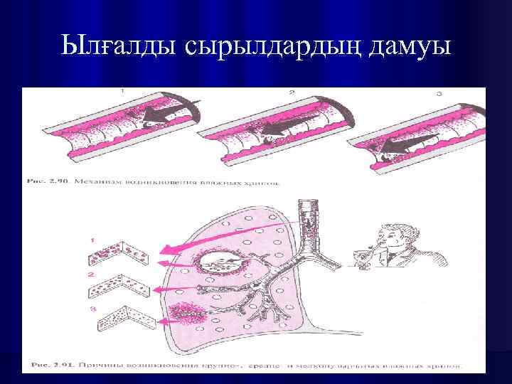 Ылғалды сырылдардың дамуы 