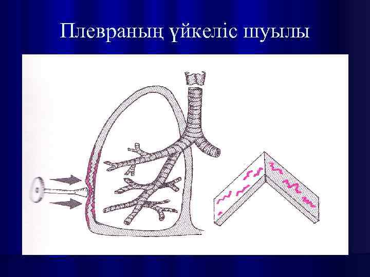 Плевраның үйкеліс шуылы 