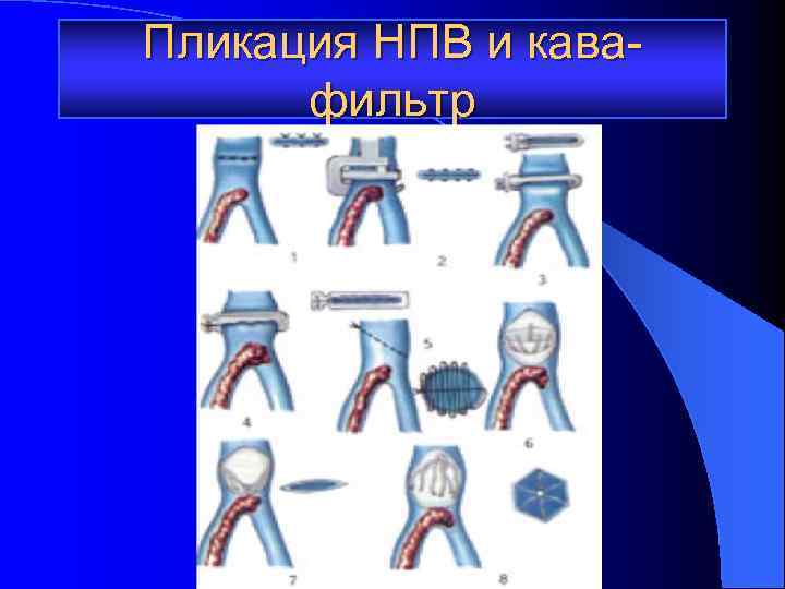 Пликация НПВ и кавафильтр 