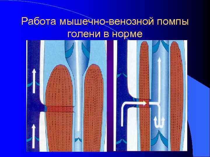 Работа мышечно-венозной помпы голени в норме 