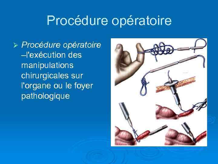 Procédure opératoire Ø Procédure opératoire –l'exécution des manipulations chirurgicales sur l'organe ou le foyer