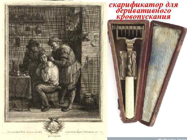 скарификатор для деривативного кровопускания 