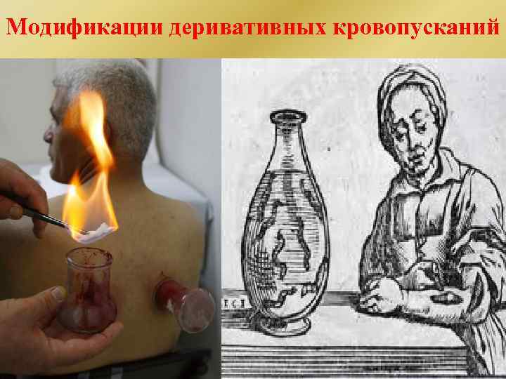 Модификации деривативных кровопусканий 