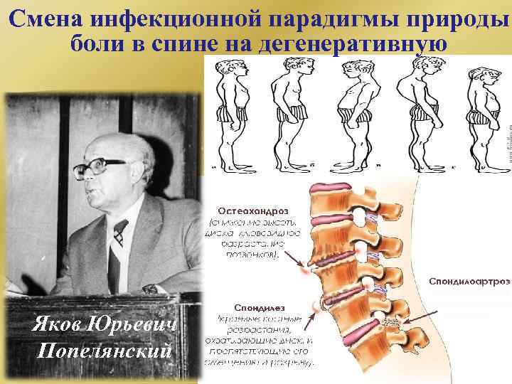 Смена инфекционной парадигмы природы боли в спине на дегенеративную Яков Юрьевич Попелянский 
