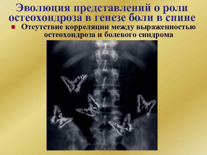 Эволюция представлений о роли остеохондроза в генезе боли в спине n Отсутствие корреляции между